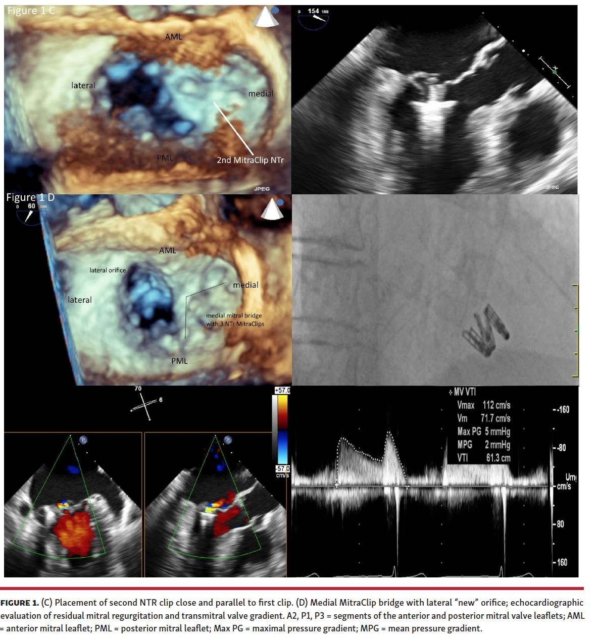 Treating Mitral Valve Prolapse in Barlow’s Disease by Creation of a